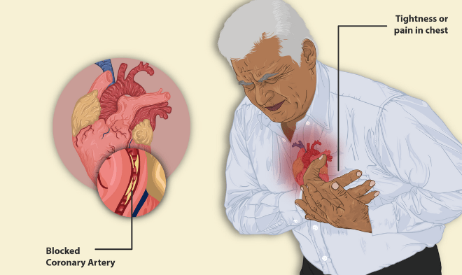 Angina Treatment With Eecp Therapy In India Oplus Heart Centre