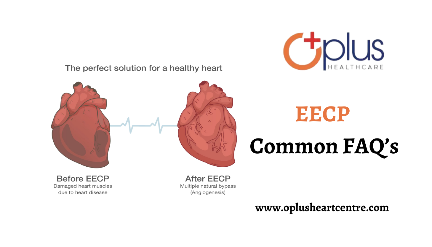 EECP Common FAQ To Ask your Cardiologist