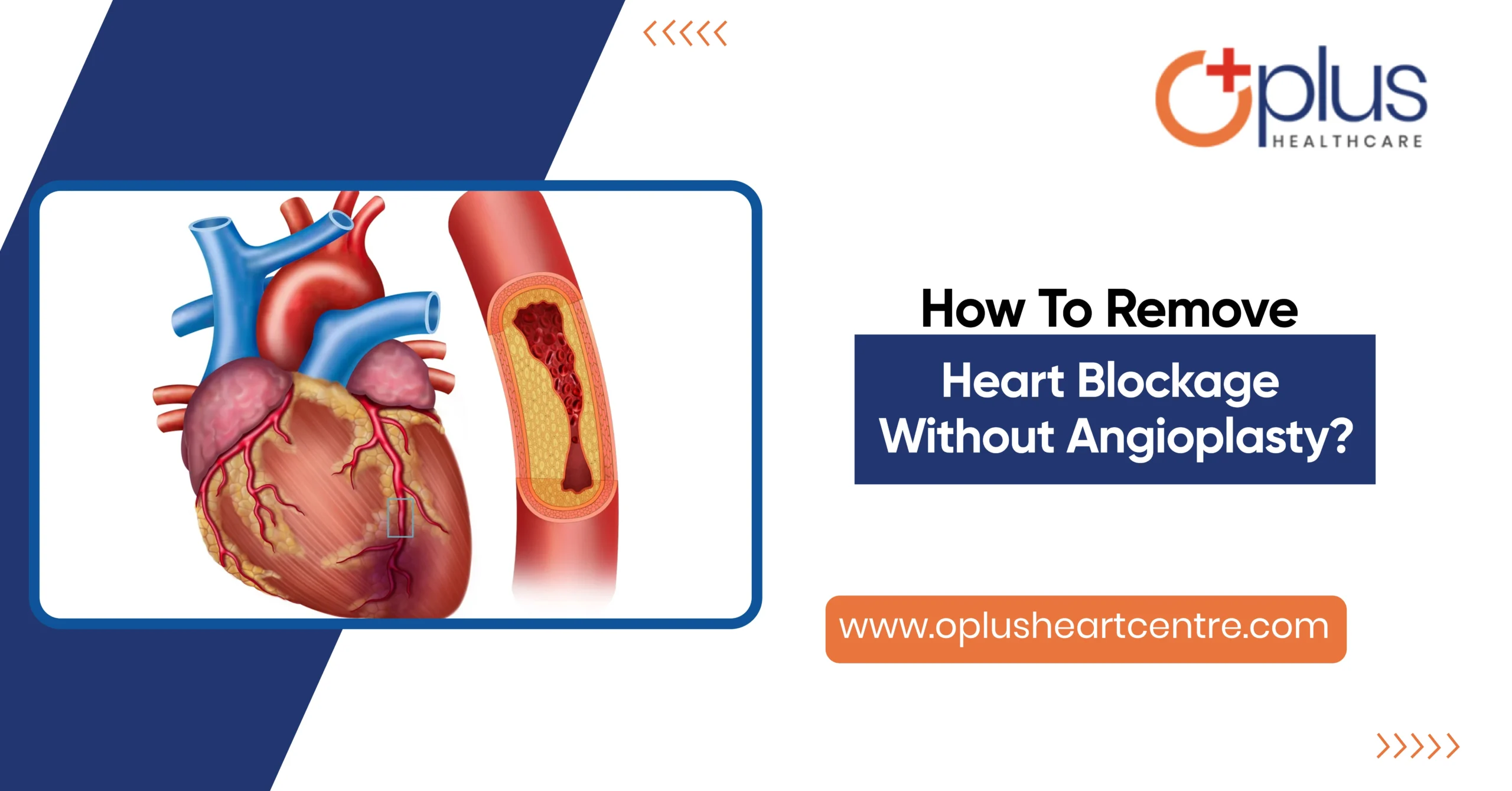 How To Remove Heart Blockage Without Angioplasty?